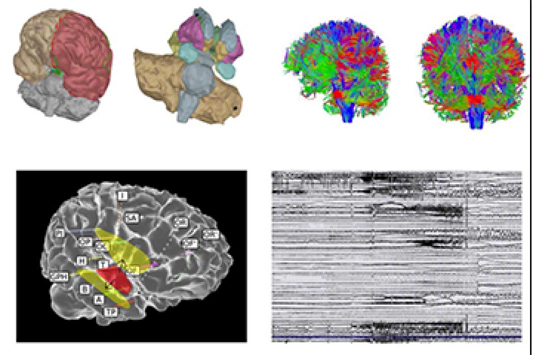 Cérebro virtual ajuda a decifrar a epilepsia