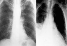 Como tratar a tuberculose quando os antibióticos já não funcionam