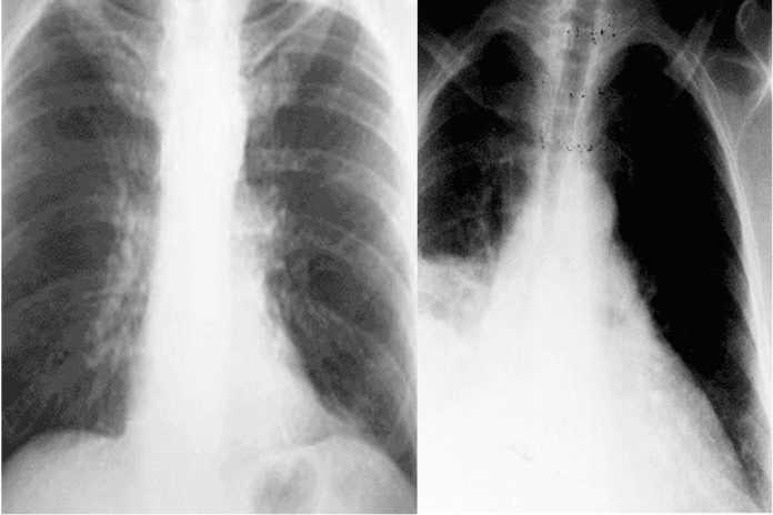 Como tratar a tuberculose quando os antibióticos já não funcionam