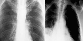 Tuberculose persistir nos pulmões depois do tratamento