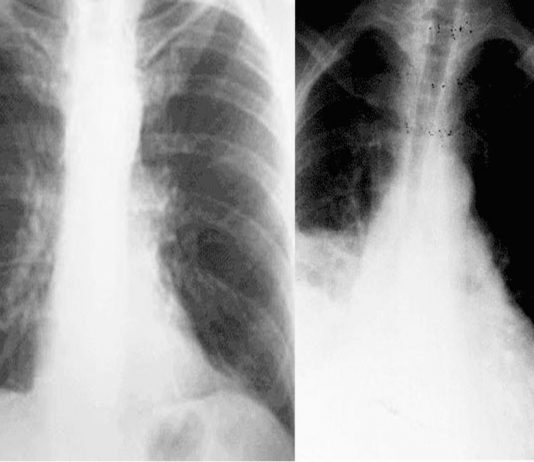 Tuberculose persistir nos pulmões depois do tratamento