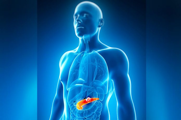 Cancro do pâncreas: proteína específica promove desenvolvimento de pancreatite e tumores