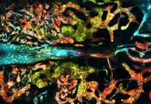 Tratamento de leucemia pode melhorar com medicamento para excesso de ferro Medula óssea saudável (amarela) invadida por leucemia, com vasos sanguíneos em ciano (vermelho).