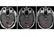 Imagens de cérebro com glioblastoma