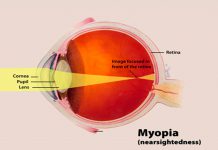 Diagrama de miopia no olho humano