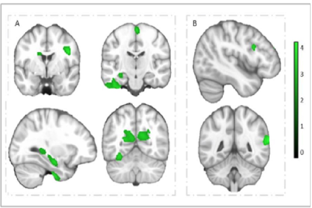 Regiões cerebrais que mostram associações positivas da aptidão cardiorrespiratória e agilidade com o volume da matéria cinzenta, em crianças com excesso de peso ou obesas. Imagem: DR