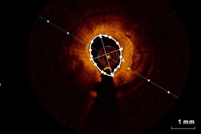 Modelo matemático para simular libertação de fármacos por stents, criado na UC