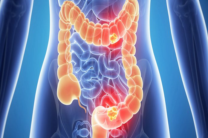 Medicina personalizada melhora tratamento do cancro do intestino
