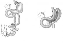 Dois tipos de cirurgia para obesidade severa: no caso de bypass gástrico, parte do estomago é do intestino delgado é ignorado (esquerda), enquanto no caso do peritoneu, o volume do estomago é reduzido (à direita).