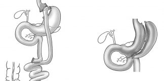 Dois tipos de cirurgia para obesidade severa: no caso de bypass gástrico, parte do estomago é do intestino delgado é ignorado (esquerda), enquanto no caso do peritoneu, o volume do estomago é reduzido (à direita).