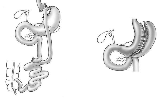 Dois tipos de cirurgia para obesidade severa: no caso de bypass gástrico, parte do estomago é do intestino delgado é ignorado (esquerda), enquanto no caso do peritoneu, o volume do estomago é reduzido (à direita).