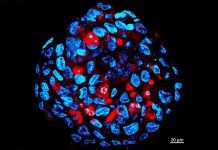 Esfera tumoral composta por células-tronco de meduloblastoma humano infetadas pelo vírus zika (vermelho)