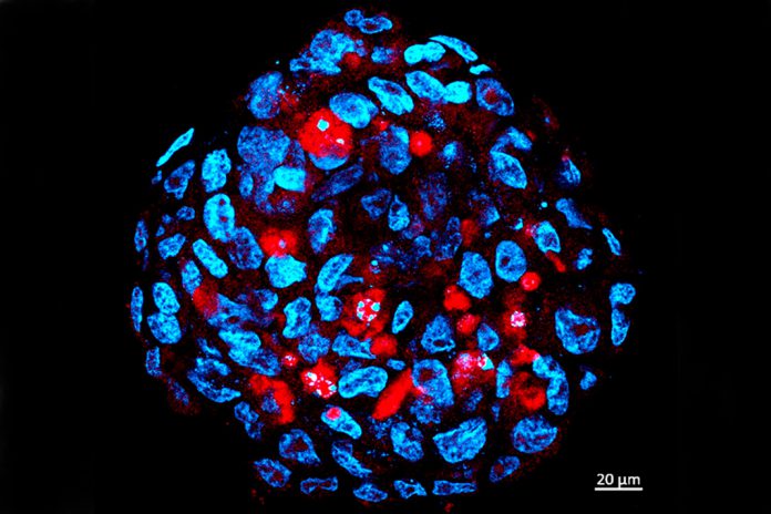 Esfera tumoral composta por células-tronco de meduloblastoma humano infetadas pelo vírus zika (vermelho) Esfera tumoral composta por células-tronco de meduloblastoma humano infetadas pelo vírus zika (vermelho)