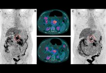 (A) 18FDG PET antes da terapia com 177Lu-3BP-227. Oval vermelho: tumor primário; setas: metástases hepáticas. (B, painel superior) Seção Axial CT; tumor primário (oval azul) antes da terapia com 177Lu-3BP-227. (B, painel inferior) Seção Axial CT; tumor primário (oval azul) após 3 ciclos de terapia com 177Lu-3BP-227. (C) 18FDG PET após 3 ciclos de terapia com 177Lu-3BP-227.