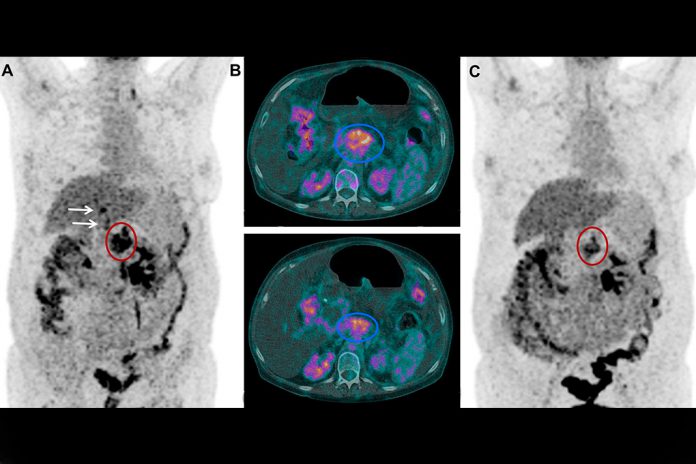 (A) 18FDG PET antes da terapia com 177Lu-3BP-227. Oval vermelho: tumor primário; setas: metástases hepáticas. (B, painel superior) Seção Axial CT; tumor primário (oval azul) antes da terapia com 177Lu-3BP-227. (B, painel inferior) Seção Axial CT; tumor primário (oval azul) após 3 ciclos de terapia com 177Lu-3BP-227. (C) 18FDG PET após 3 ciclos de terapia com 177Lu-3BP-227.
