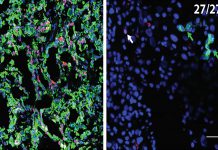 À esquerda, há uma seção do tumor primário de um paciente com cancro pancreático, com células cancerosas (vermelho) e CK19, um marcador de proliferação (verde), evidente. À direita, uma amostra do fígado no mesmo paciente revelou 27 CCDs isolados (células cancerígenas disseminadas). Essas células estão dormentes, mas ativam quando os níveis de células T no paciente diminuem, como ocorre imediatamente após uma cirurgia. Isso fornece uma pista sobre como evitar a metástase hepática em pacientes com cancro pancreático submetidos a cirurgia.