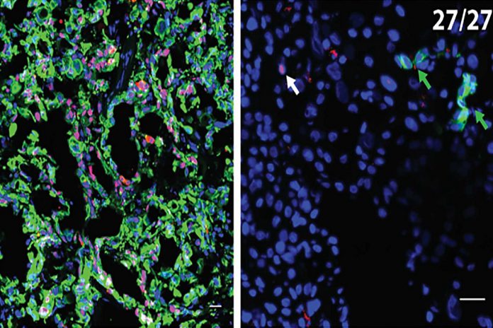 À esquerda, há uma seção do tumor primário de um paciente com cancro pancreático, com células cancerosas (vermelho) e CK19, um marcador de proliferação (verde), evidente. À direita, uma amostra do fígado no mesmo paciente revelou 27 CCDs isolados (células cancerígenas disseminadas). Essas células estão dormentes, mas ativam quando os níveis de células T no paciente diminuem, como ocorre imediatamente após uma cirurgia. Isso fornece uma pista sobre como evitar a metástase hepática em pacientes com cancro pancreático submetidos a cirurgia. À esquerda, há uma seção do tumor primário de um paciente com cancro pancreático, com células cancerosas (vermelho) e CK19, um marcador de proliferação (verde), evidente. À direita, uma amostra do fígado no mesmo paciente revelou 27 CCDs isolados (células cancerígenas disseminadas). Essas células estão dormentes, mas ativam quando os níveis de células T no paciente diminuem, como ocorre imediatamente após uma cirurgia. Isso fornece uma pista sobre como evitar a metástase hepática em pacientes com cancro pancreático submetidos a cirurgia.