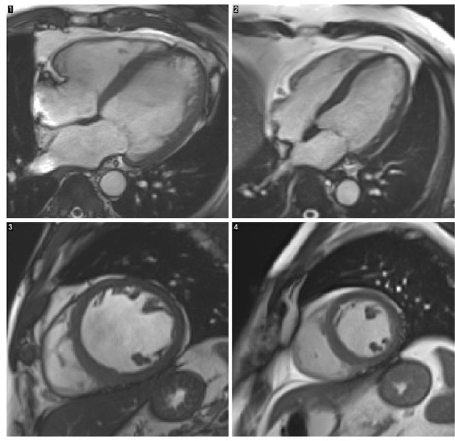 1. A imagem mostra um corte transversal de um coração com cardiomiopatia alcoólica. O tamanho total do coração está aumentado. A principal câmara de bombeamento do coração (na imagem como a grande área em direção à direita do coração) também é aumentada, com paredes finas. Isto torna o coração menos eficiente. 2. Esta imagem mostra um corte transversal de um coração saudável, onde a câmara de bombeamento principal (chamada de ventrículo esquerdo) tem tamanho normal. 3. Esta imagem mostra um coração com cardiomiopatia alcoólica, mas é um corte transversal no meio do coração, como se estivesse olhando para baixo a partir do 'topo'. Isso mostra que a principal câmara de bombeamento (o ventrículo esquerdo) está aumentada. 4. A imagem mostra um corte transversal de um coração saudável.