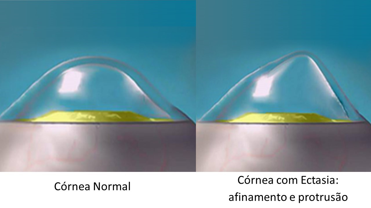 Ceratocone uma preocupação para paciente e médico