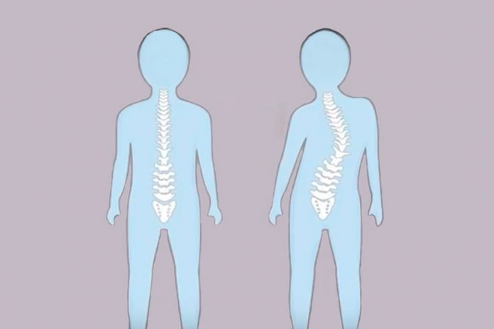 Vídeo permite sensibilizar crianças para a escoliose