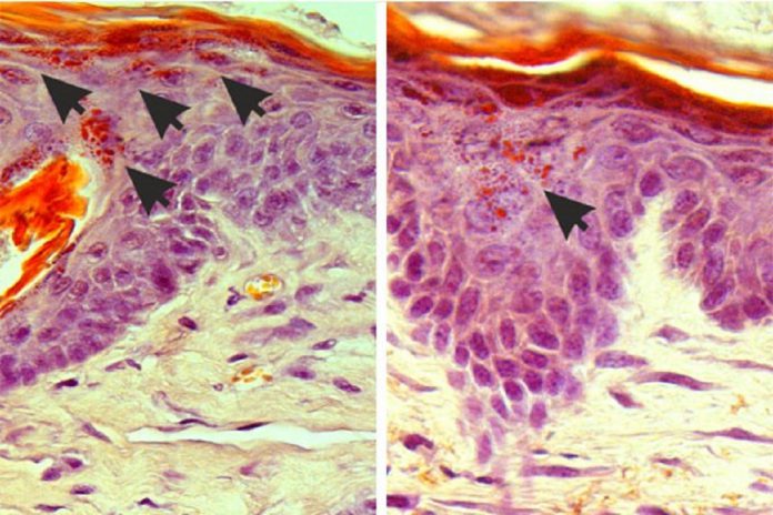 Eczema: Luz permite parar a comichão. Imagem: © Paul Heppenstall e Linda Nocchi / EMBL