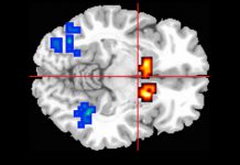 Extrato de cannabis ajuda a restaurar função cerebral na psicose