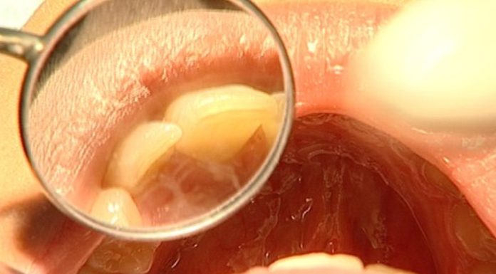 Especialistas em saúde oral desmistificam crenças que podem comprometer a saúde Especialistas em saúde oral desmistificam crenças que podem comprometer a saúde