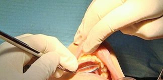 Perda dentária tem diversas implicações incluindo na nutrição em idosos