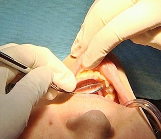 Perda dentária tem diversas implicações incluindo na nutrição em idosos