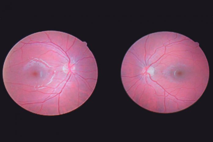 Glaucoma pode ter na origem uma doença autoimune