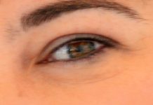 Os riscos de desenvolver glaucoma