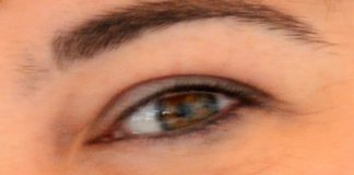 Os riscos de desenvolver glaucoma