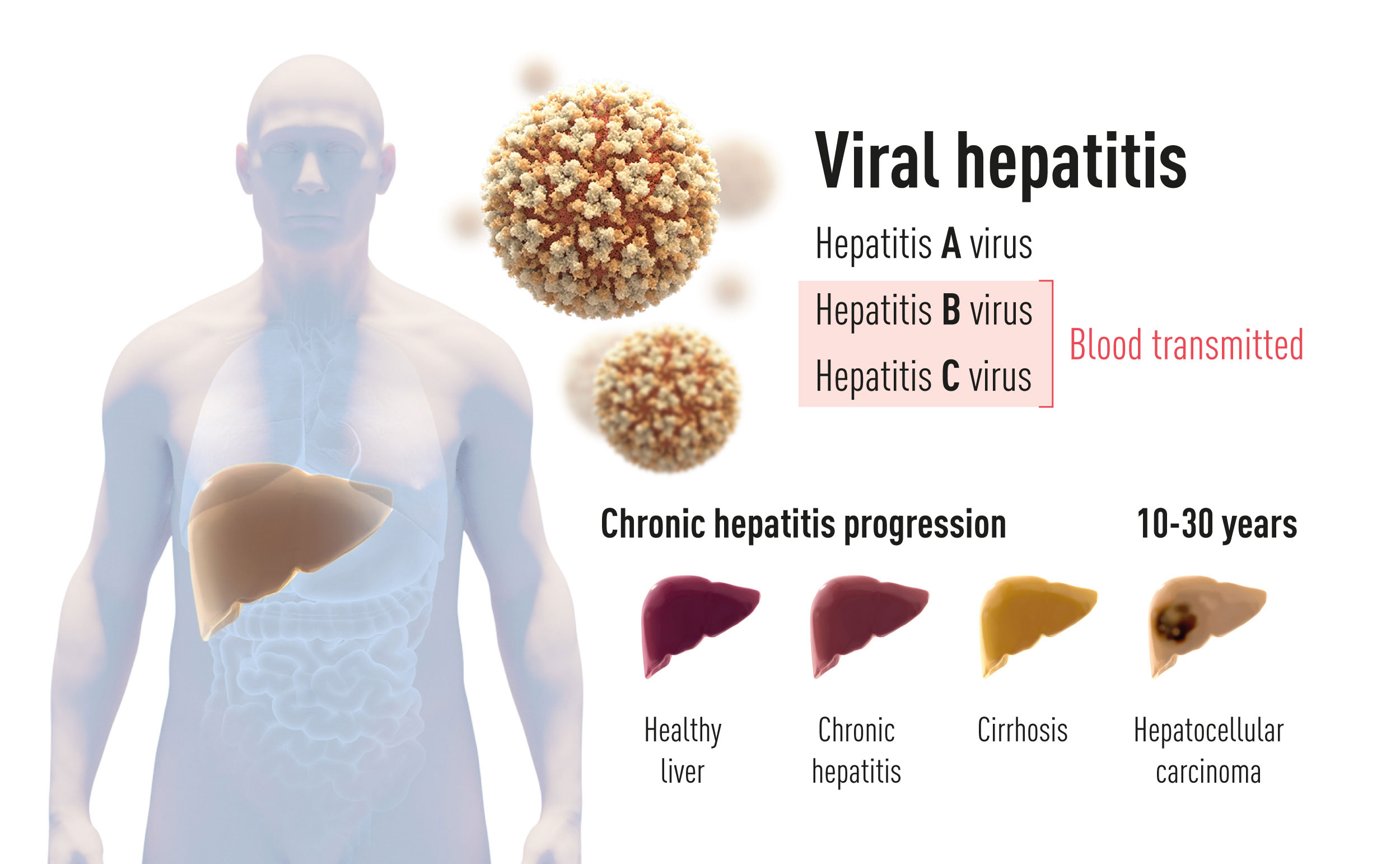 Existem duas formas principais de hepatite. Uma é uma doença aguda causada pelo vírus da hepatite A, que é transmitido pela água ou alimentos contaminados. A outra, causada pelo vírus da hepatite B ou vírus da hepatite C. Esta última de hepatite sanguínea pode levar a uma doença crónica que pode progredir para cirrose e carcinoma hepatocelular.