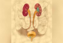 Tumores (células azuis) da bexiga e do trato urinário superior podem ser detetados pelo UroSEEK, o novo teste é baseado na análise genética de células libertas para a urina