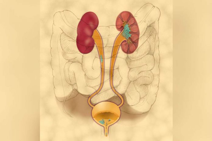 Tumores (células azuis) da bexiga e do trato urinário superior podem ser detetados pelo UroSEEK, o novo teste é baseado na análise genética de células libertas para a urina