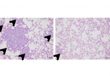 Células do cancro da mama tipo basal formam múltiplos tumores metastáticos (cabeças de setas) nos pulmões (ratos de controle), à esquerda, mas a metástase desaparece com o tratamento com ácido zoledrónico, à direita