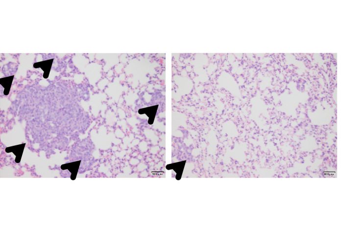 Células do cancro da mama tipo basal formam múltiplos tumores metastáticos (cabeças de setas) nos pulmões (ratos de controle), à esquerda, mas a metástase desaparece com o tratamento com ácido zoledrónico, à direita