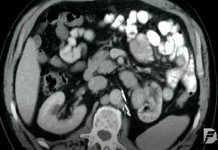 Tratamento do cancro renal avançado mais eficiente com nova terapia