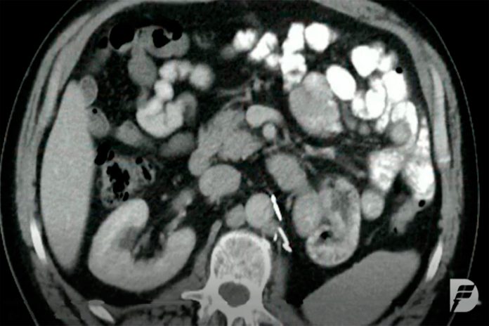 Tratamento do cancro renal avançado mais eficiente com nova terapia Tratamento do cancro renal avançado mais eficiente com nova terapia
