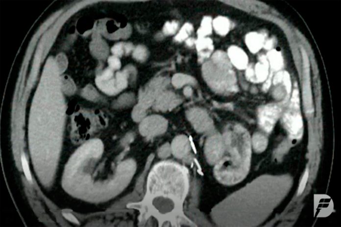 Tratamento do cancro renal avançado mais eficiente com nova terapia