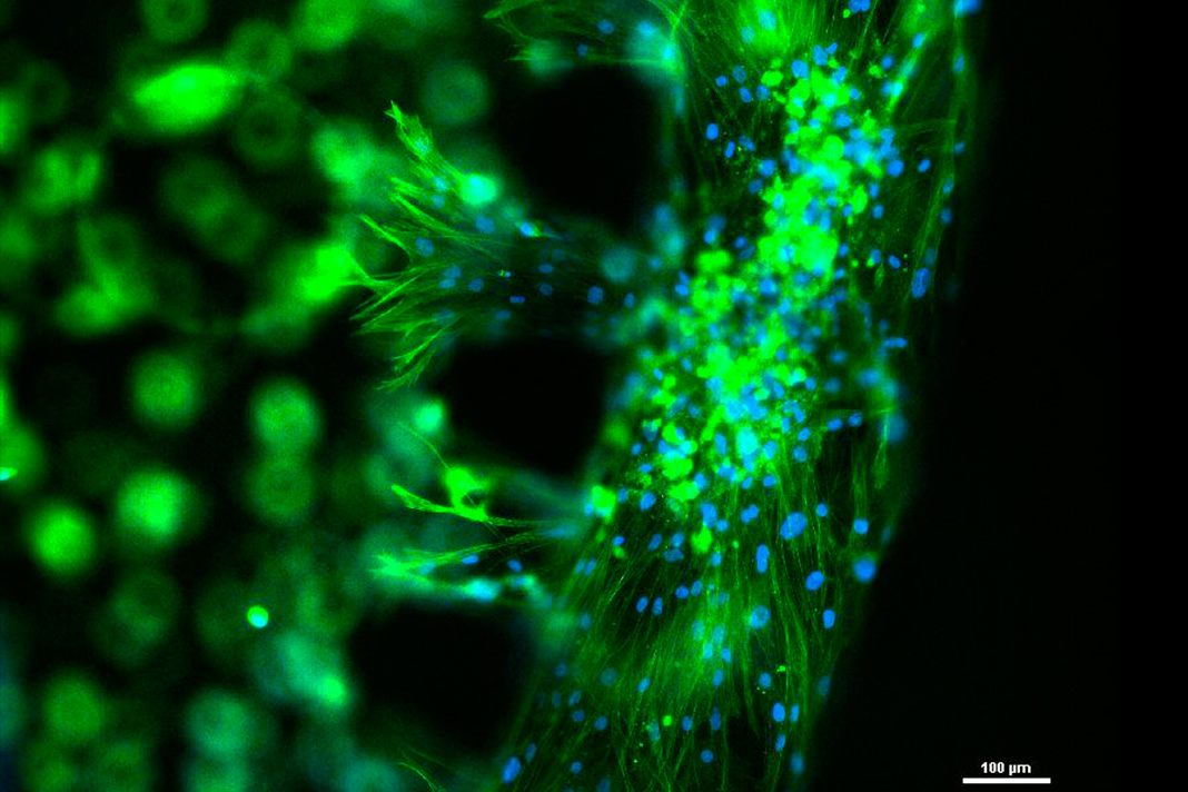 Teste de medicamentos para cancro colorretal desenvolvido na Universidade do Minho