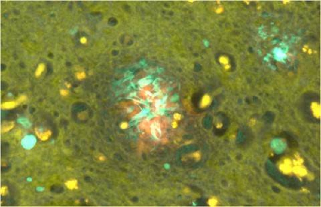 Amilóide beta (fluorescência verde) e alumínio (fluorescência laranja) na placa senil do tecido cerebral de um doador familiar da doença de Alzheimer.