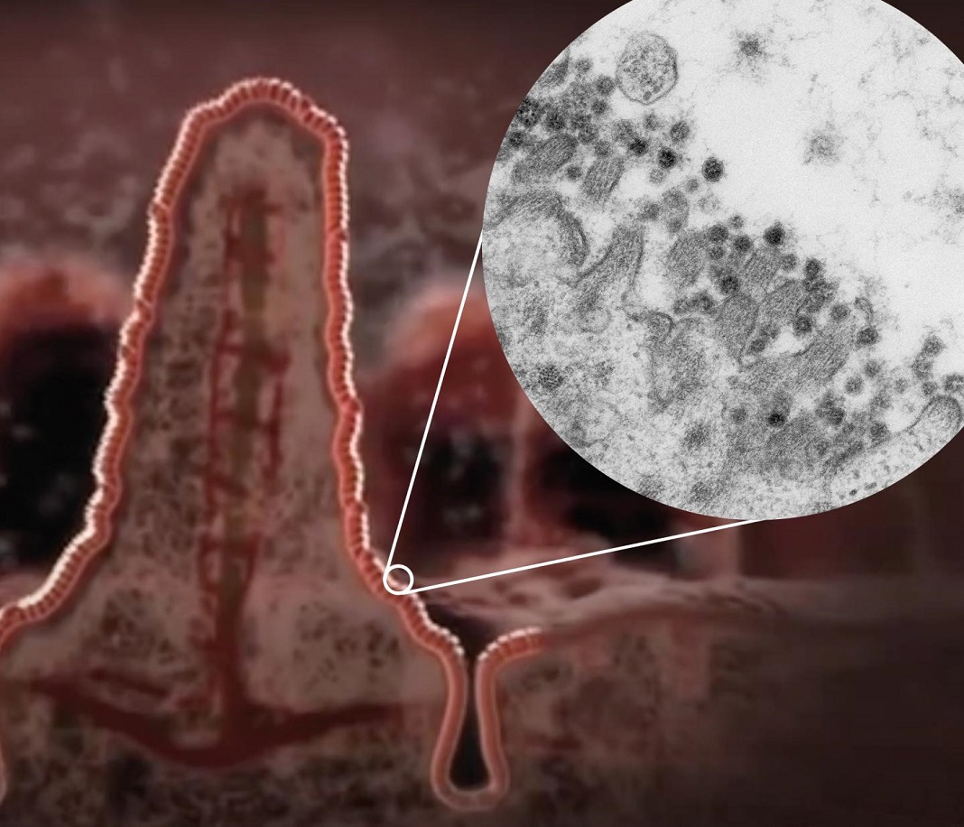 Ilustração de uma vilosidade no intestino com um zoom para uma imagem de microscopia eletrónica do coronavírus SARS-CoV-2 na borda de uma célula intestinal.