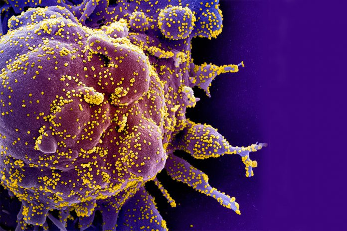 Micrografia eletrónica de varredura colorida de uma célula apoptótica (roxa) fortemente infetada com partículas do vírus SARS-COV-2 (amarela), isolada de uma amostra de paciente. Imagem capturada no NIAID Integrated Research Facility (IRF) em Fort Detrick, Maryland.