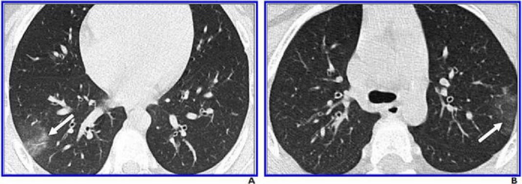 Imagem: A e B, a TC de tórax sem melhoras mostra Opacidades em Vidro Fosco mínimos (lóbulos superiores direito e esquerdo) (setas) e sem consolidação. Apenas dois lobos foram afetados, e os achados da TC receberam escore de gravidade de 2. © American Journal of Roentgenology (AJR)