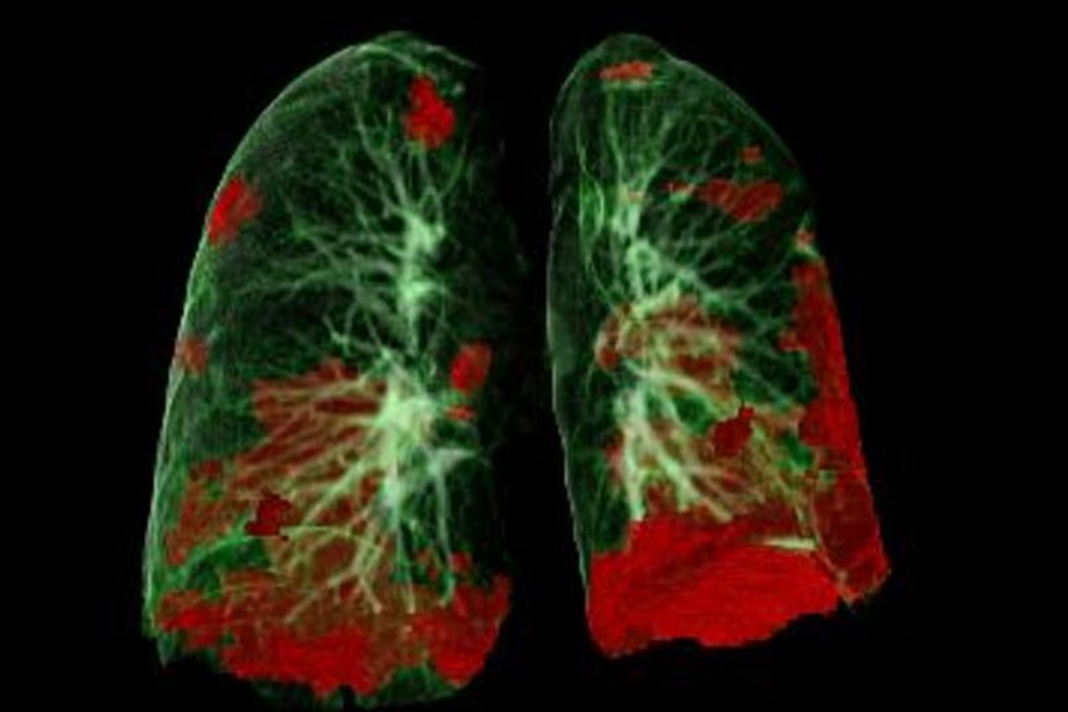 Tomografia computadorizada dos pulmões do paciente mostrando dano da COVID-19 a vermelho