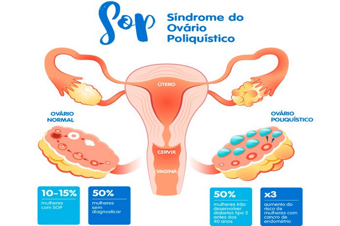 Síndrome do ovário poliquístico pode causar infertilidade