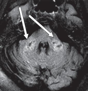 Imagem de RM FLAIR axial mostra prolongamento de T2 em pedúnculos cerebelares médios bilaterais (setas). Os achados foram associados a difusão restrita e áreas de sinal hipointenso T1 sem realce ou suscetibilidade anormal.