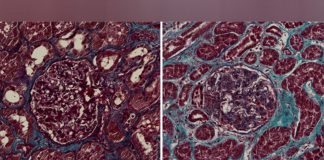 Coronavírus da COVID-19 infeta os rins e leva à formação de cicatrizes