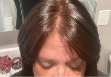 COVID-19 pode provocar perda excessiva de cabelo